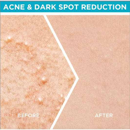 Garnier Fast Clear Serum for Acne Prone Skin - 15ml